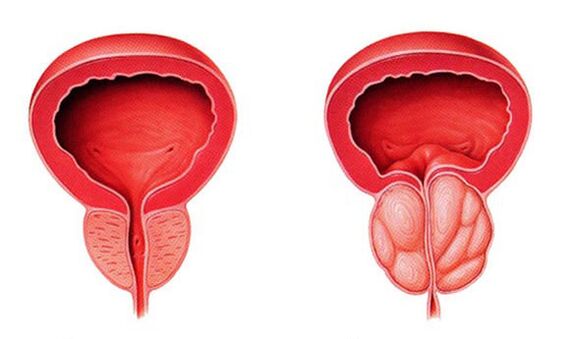 Normale en ontstoken prostaat (prostatitis)