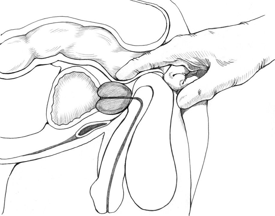 Prostaatmassage is opgenomen in het complex van behandelmethoden voor prostatitis